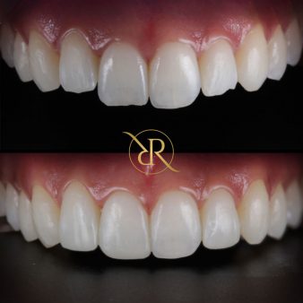 dr-rashpal-reel-before-after-img-7