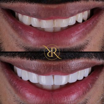 dr-rashpal-reel-before-after-img-8