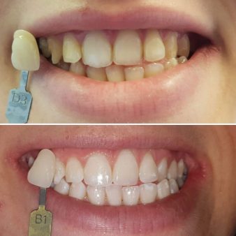 imperial-before-after-img-1