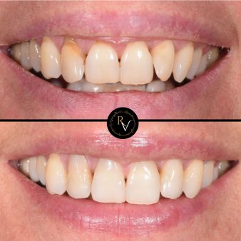 rv-before-after-img-1