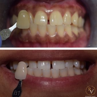 rv-before-after-img-3