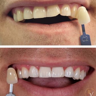 teeth-whitening-img-4