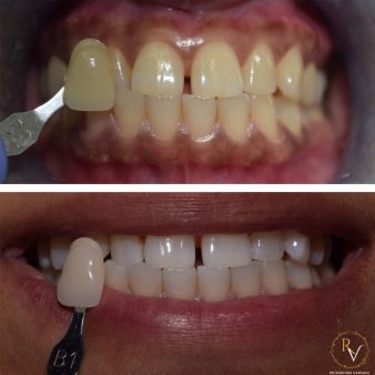 teeth-whitening-img-5